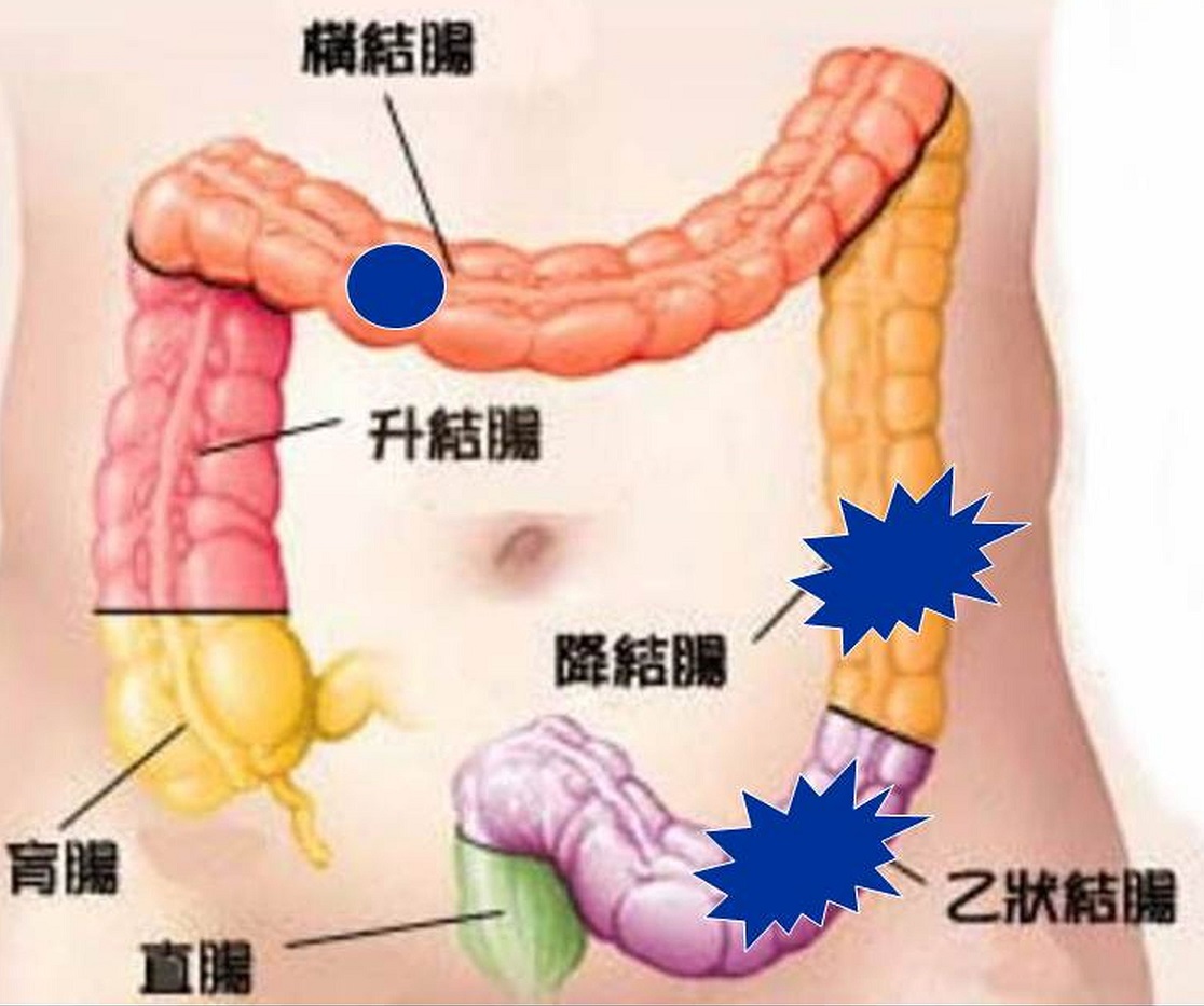 大腸癌早期發現並治療 病魔不上身