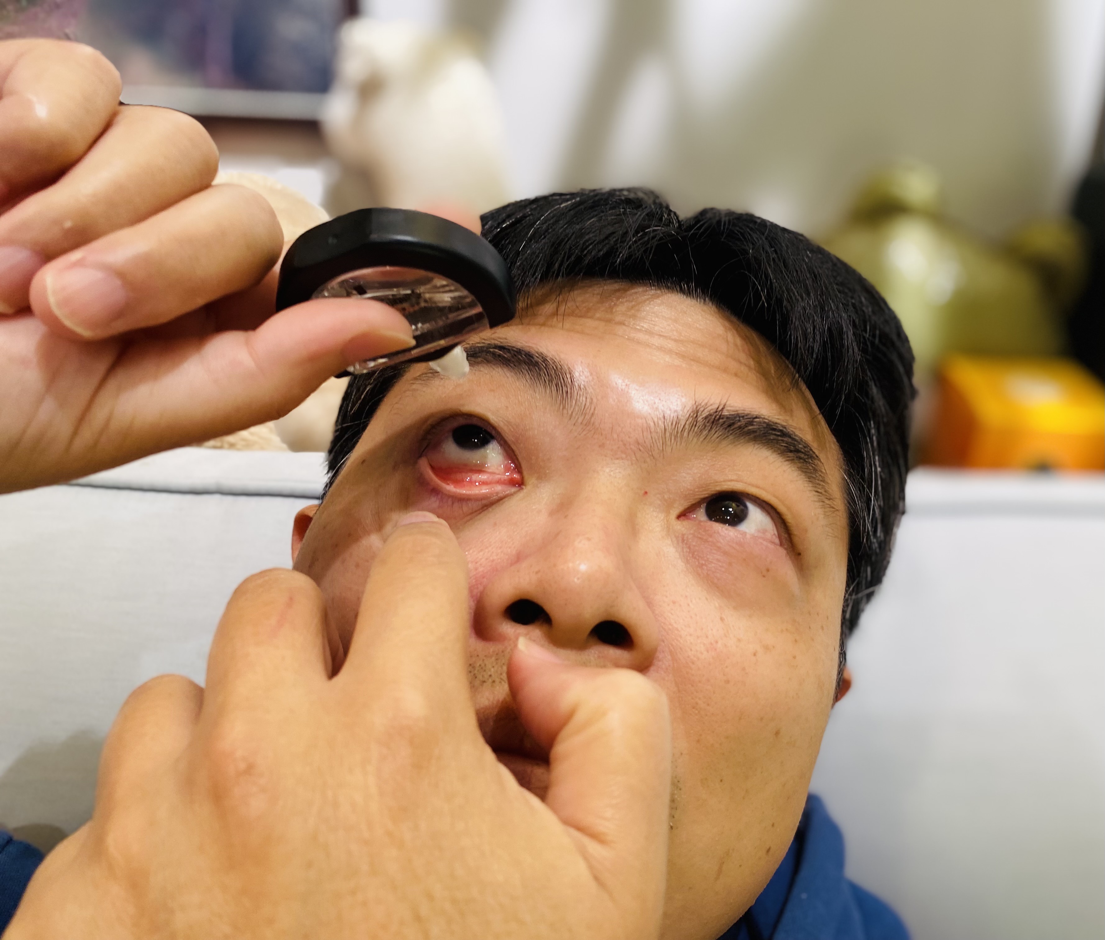 愛吃油炸、經常熬夜 小心針眼找上門！ 