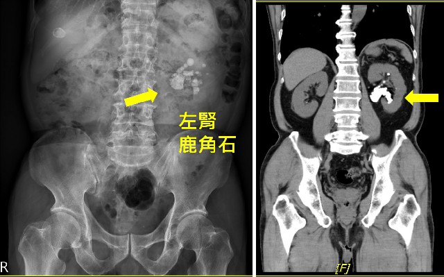 雙鏡聯合碎石術   複雜鹿角腎結石一次清    病人保腎傷口小復原快