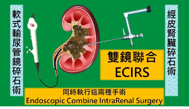 雙鏡聯合碎石術   複雜鹿角腎結石一次清    病人保腎傷口小復原快